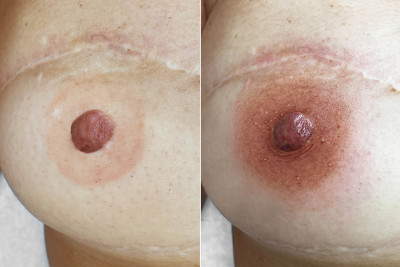 Breast areola reconstruction helps to regain self-confidence and femininity