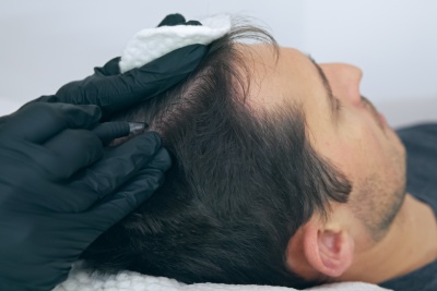 Dermopigmentation Center explains how to camouflage a scar with capillary micropigmentation