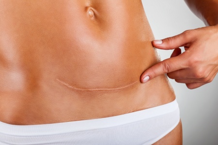 With micropigmentation, the scar or stretch mark is visibly reduced.