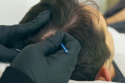 Dermopigmentation Center explains how does a hair densification through a micropigmentation procedure work.