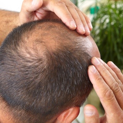 Traitement contre la perte de cheveux en Belgique : étapes