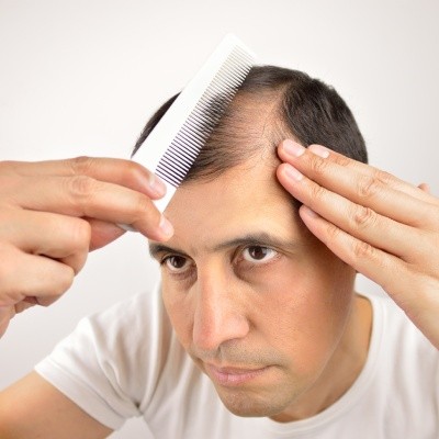 Perte de cheveux chez l’homme : comment se coiffer ?