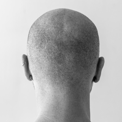 Scalp micropigmentation due to alopecia in Marbella: advantages