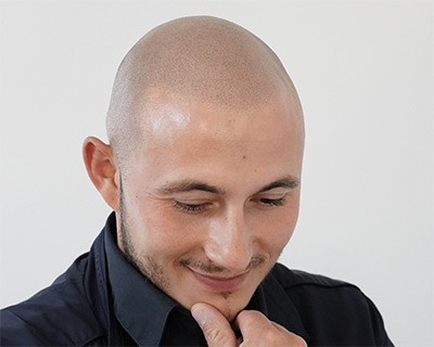 Scalp micropigmentation, shaved head effect, in Belgium